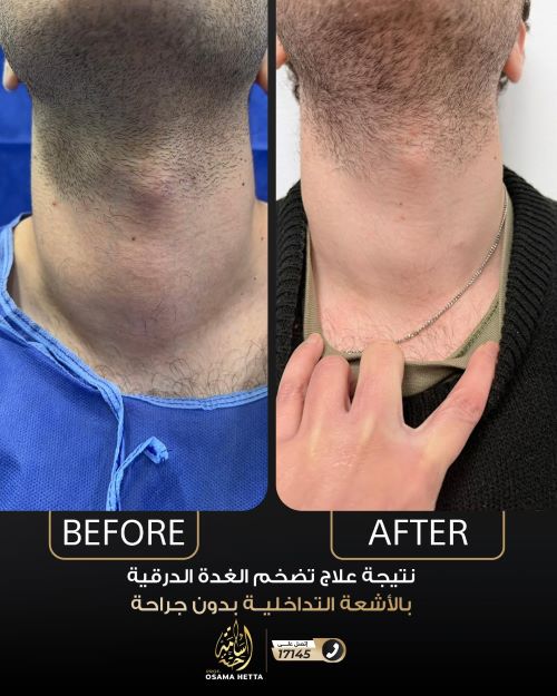 علاج عقد الغدة الدرقية بدوان جراحة